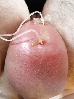 Saline Infusion