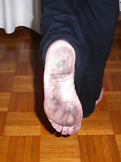 Piedi con piante callose e sporche