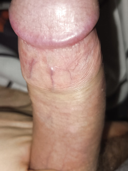 Stretching foreskin to the limit